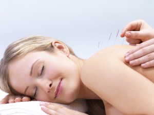 Acupuncture needles on the back of a beautiful woman